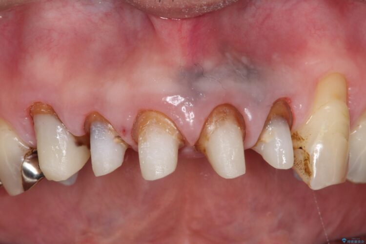 上の前歯の根元が黒い　根の治療を含めたセラミック再治療 治療途中画像