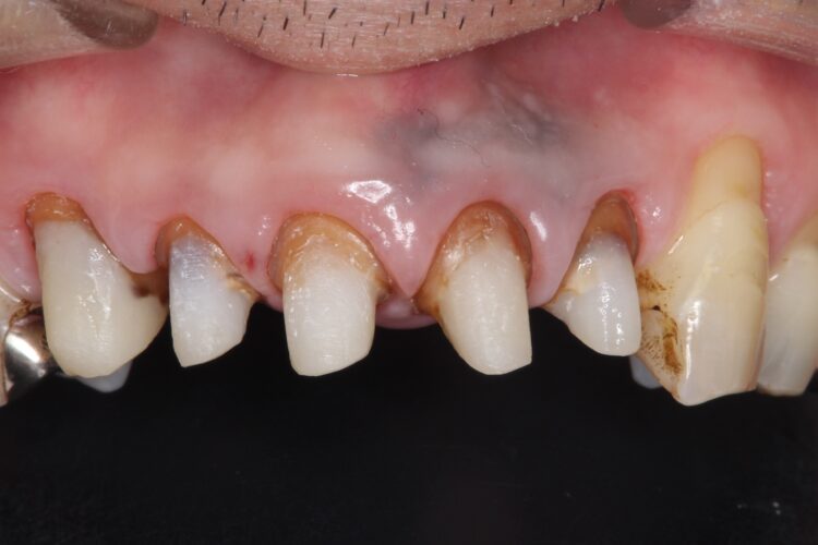 上の前歯の根元が黒い　根の治療をしてからセラミックの再治療 治療途中画像