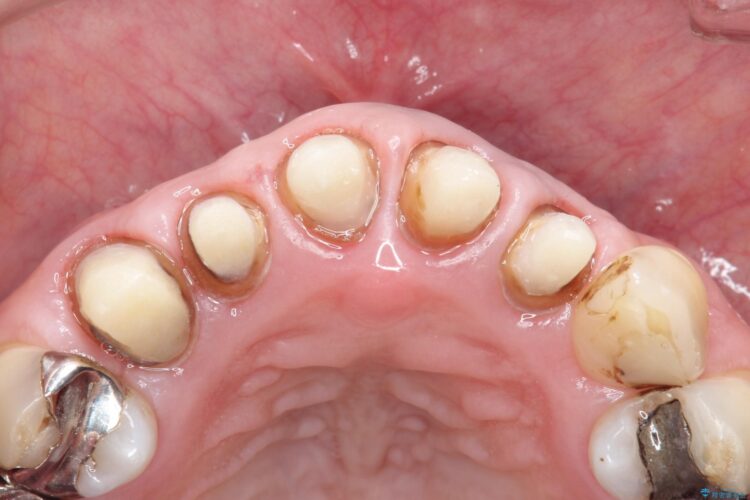 上の前歯の根元が黒い　根の治療を含めたセラミック再治療 治療途中画像