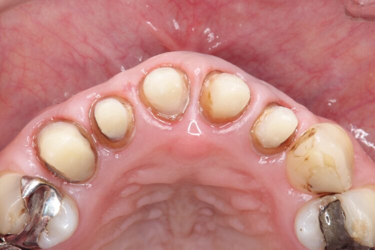 上の前歯の根元が黒い　根の治療をしてからセラミックの再治療 治療途中画像