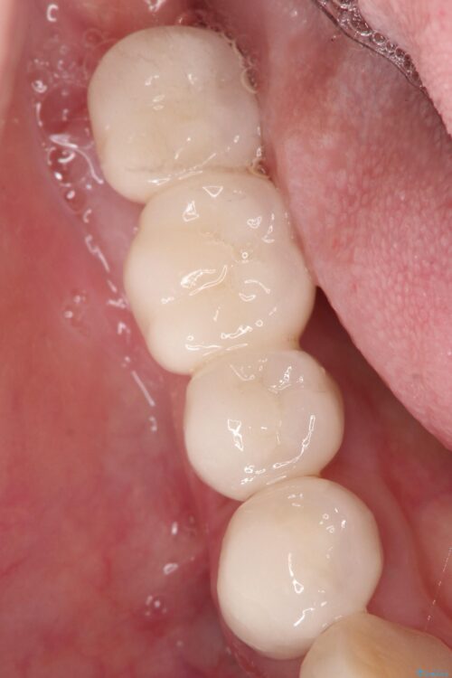 失った奥歯　インプラントブリッジで咬合回復 治療後画像