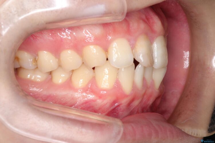 インビザラインとセラミック治療　理想的な歯並びへ 治療前画像