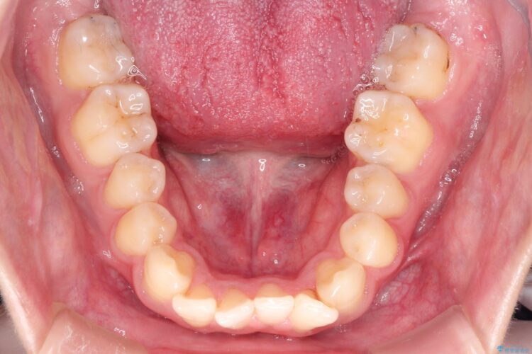 インビザラインとセラミック治療　理想的な歯並びへ 治療前画像