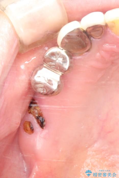 奥歯で咬むことができない　インプラントとセラミックによる咬み合わせの回復 治療前画像