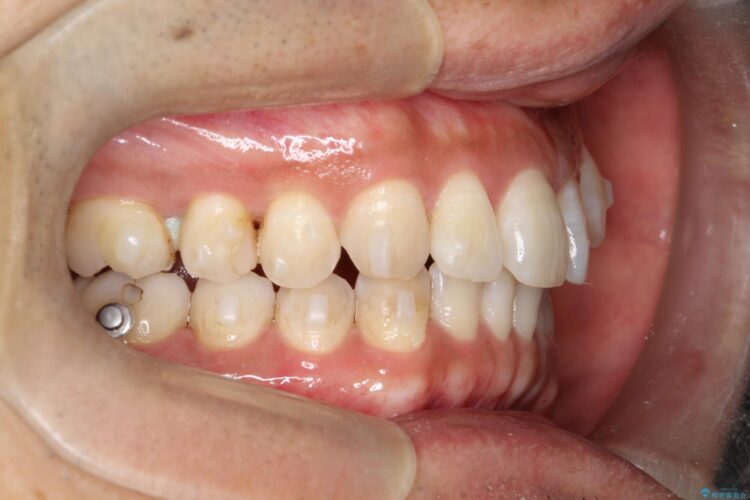 八重歯をインビザラインで矯正　成人の目立たない矯正 治療途中画像