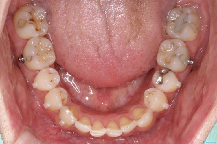 八重歯をインビザラインで矯正　成人の目立たない矯正 治療途中画像