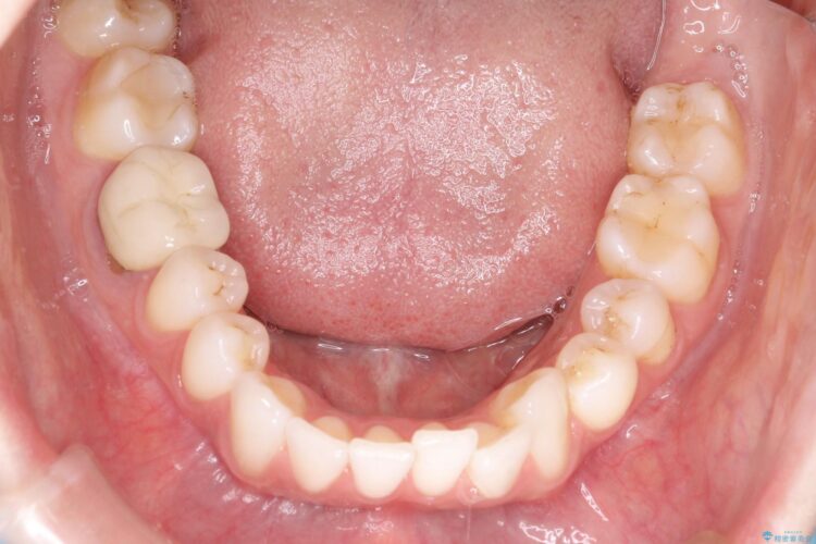 インビザラインによる非抜歯での八重歯の矯正 治療前画像