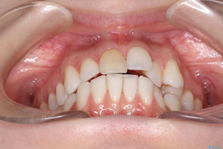インビザラインによる非抜歯での八重歯の矯正 治療前画像
