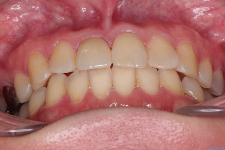 インビザラインにて矯正　その後に前歯のセラミッククラウン治療 治療後画像
