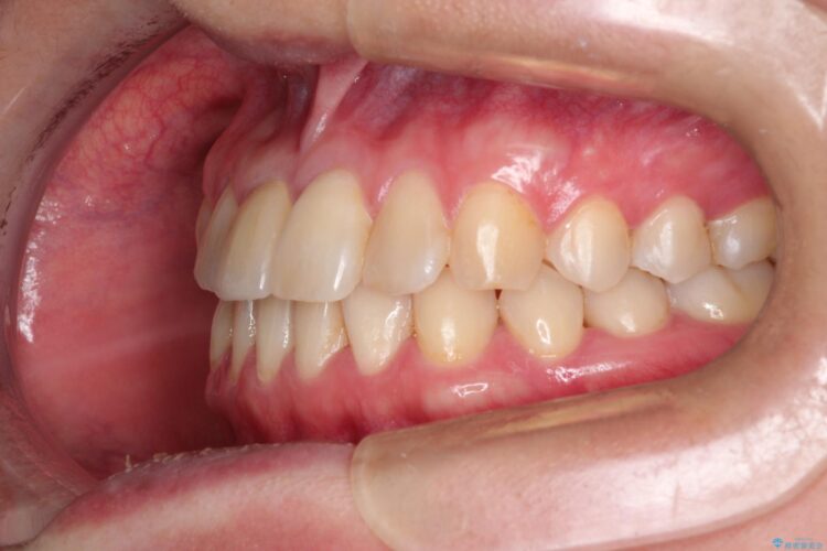 インビザラインにて矯正　その後に前歯のセラミッククラウン治療 治療後画像