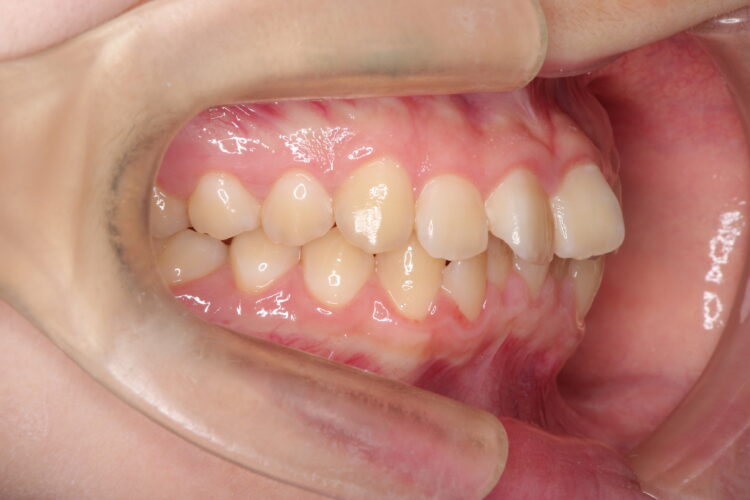 通院回数を減らして矯正したい　インビザラインでの歯並び矯正 治療前画像