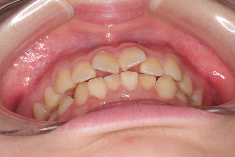 通院回数を減らして矯正したい　インビザラインでの歯並び矯正 治療前画像