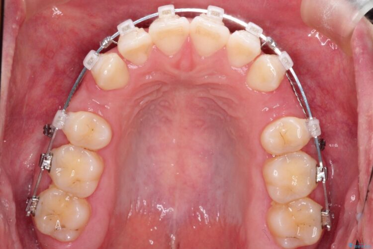 [口ゴボ] 　ワイヤーによる抜歯矯正で口元をすっきりと 治療途中画像
