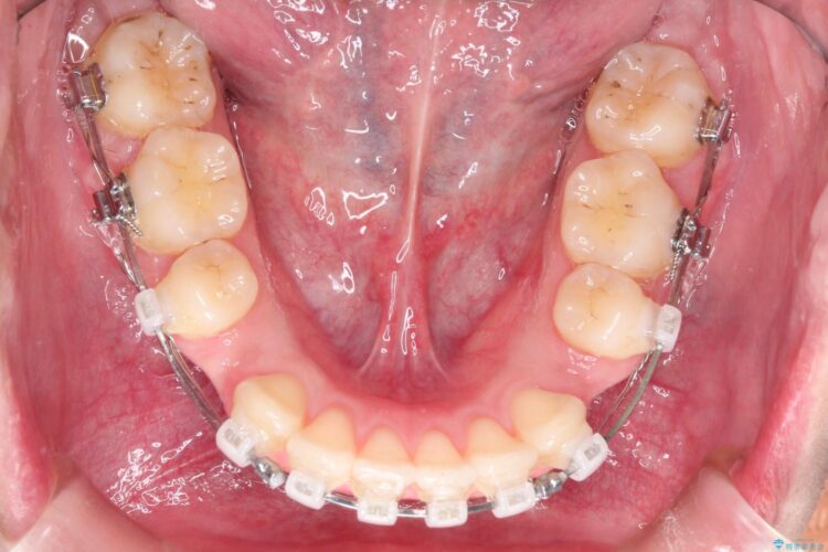 [口ゴボ] 　ワイヤーによる抜歯矯正で口元をすっきりと 治療途中画像