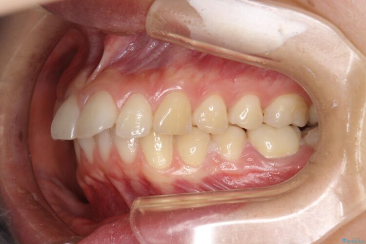 出っ歯の矯正　抜歯をしてしっかり引っ込めるワイヤー矯正 治療前画像