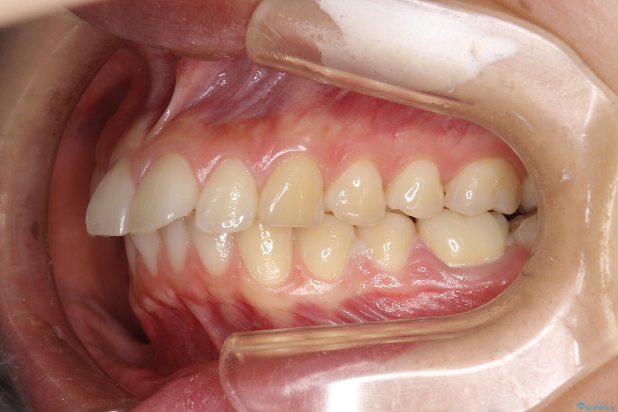 出っ歯の矯正　抜歯をしてしっかり引っ込めるワイヤー矯正 治療前