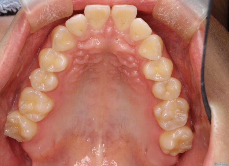 出っ歯の矯正　抜歯をしてしっかり引っ込めるワイヤー矯正 治療前画像