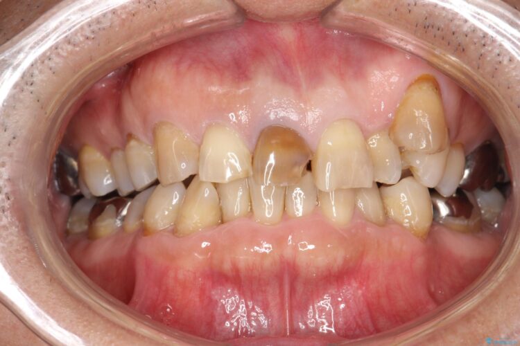 セラミックによる前歯の変色の改善 治療前画像