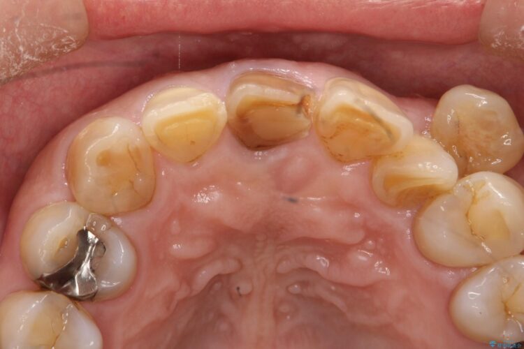 セラミックによる前歯の変色の改善 治療前画像
