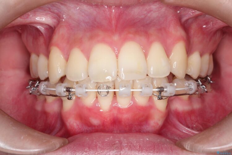 口元が出てるの気になる　ハーフリンガルによる抜歯矯正での横顔改善 治療途中画像