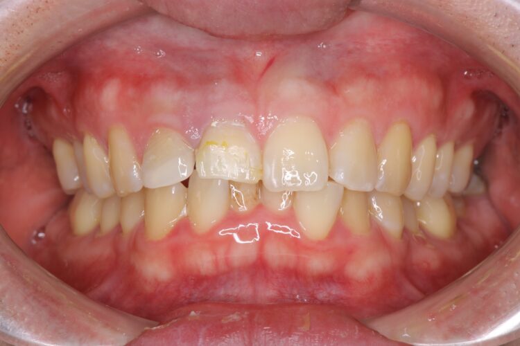 歯を白くしてからセラミック治療をしたい 治療前画像