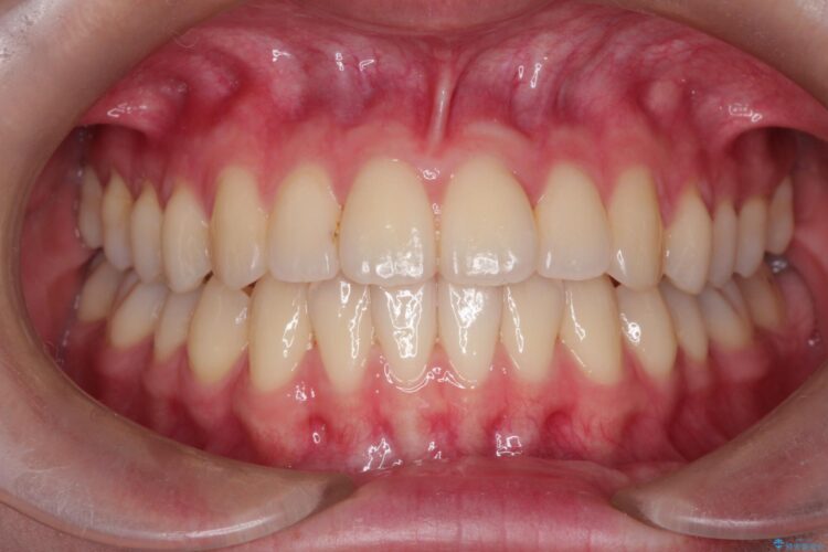 インビザラインによる非抜歯矯正　ガタガタな歯並びを整った歯並びへ アフター
