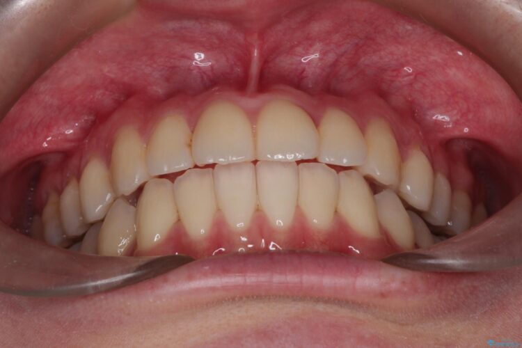 インビザラインによる非抜歯矯正　ガタガタな歯並びを整った歯並びへ 治療後画像