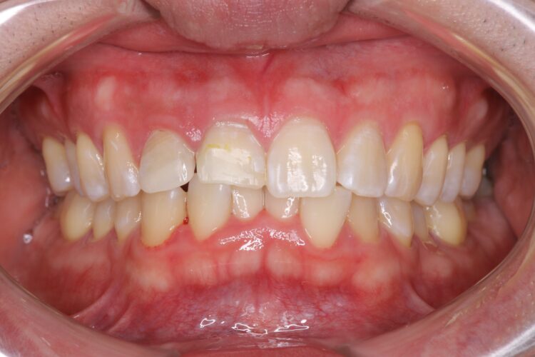 歯を白くしてからセラミック治療をしたい 治療後画像