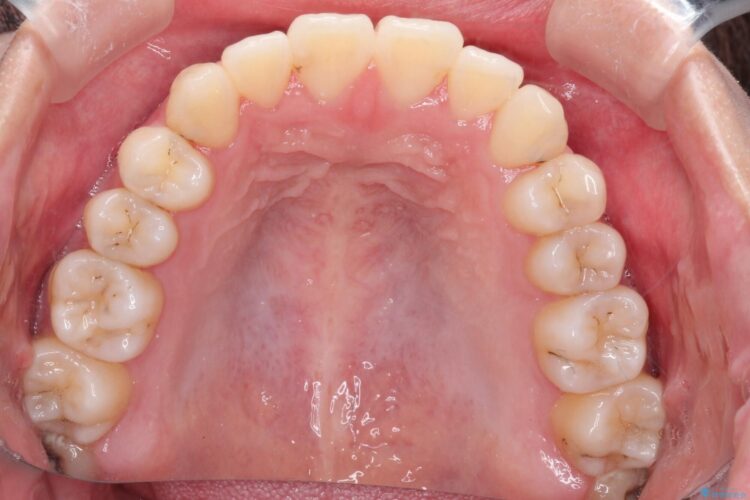 インビザラインによる非抜歯矯正　ガタガタな歯並びを整った歯並びへ 治療後画像
