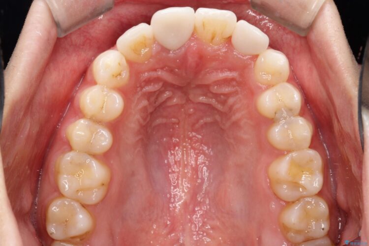 インビザラインとセラミック治療　理想的な歯並びへ 治療後画像