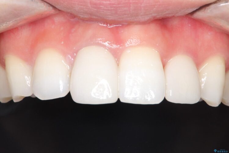 インビザラインとセラミック治療　理想的な歯並びへ 治療後画像