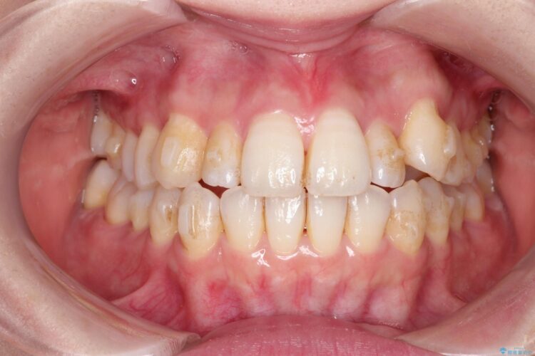 インビザラインによる八重歯の矯正　 治療途中画像