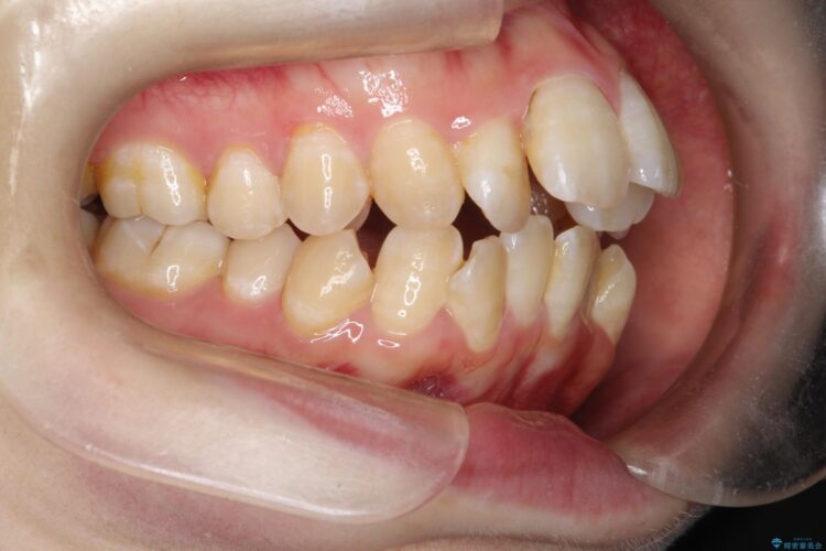 重度のガタガタ　ワイヤーによる抜歯矯正 治療前画像