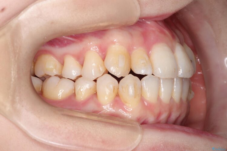 インビザラインによる八重歯の矯正　 治療途中画像