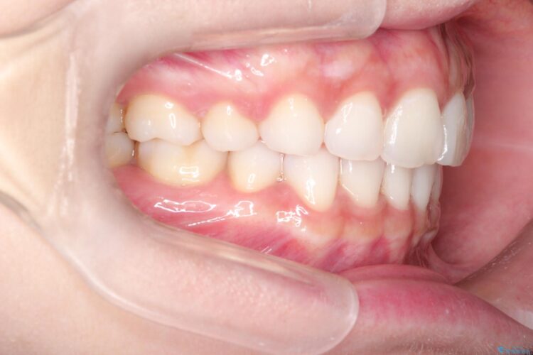 口が閉じにくい　口ゴボの抜歯矯正による改善 アフター