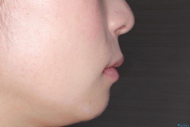 口が閉じにくい　口ゴボの抜歯矯正による改善 治療後画像