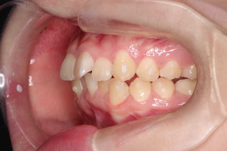 通院回数を減らして矯正したい　インビザラインでの歯並び矯正 治療途中画像