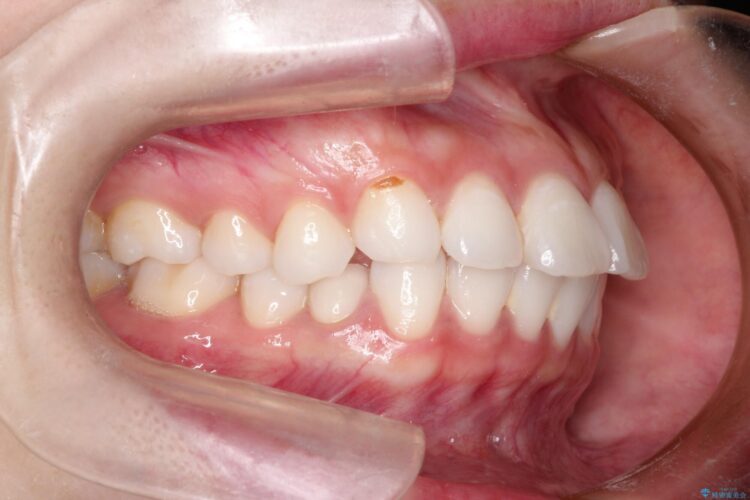 口が閉じにくい　口ゴボの抜歯矯正による改善 治療前画像
