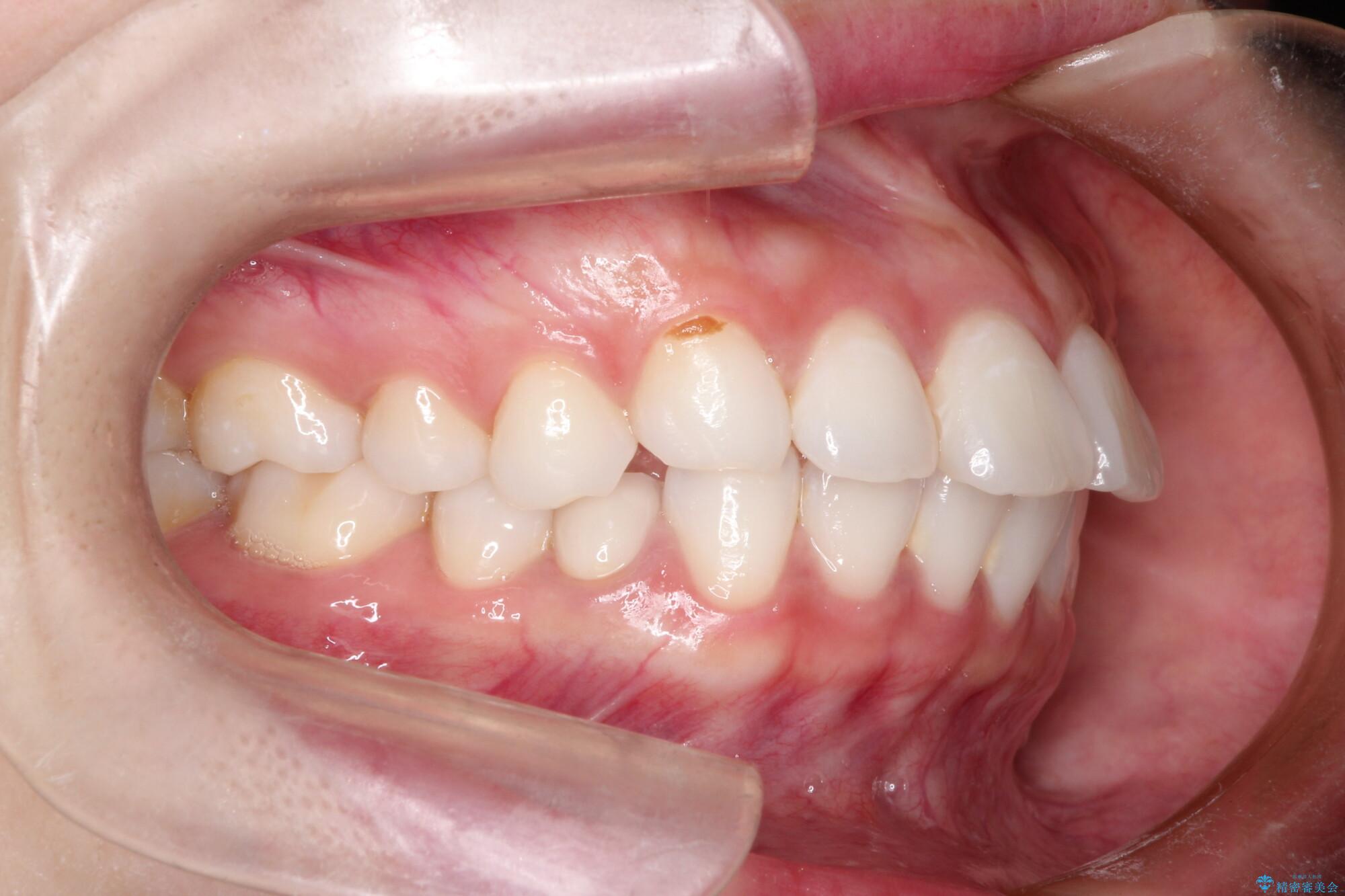 口が閉じにくい　口ゴボの抜歯矯正による改善 治療前