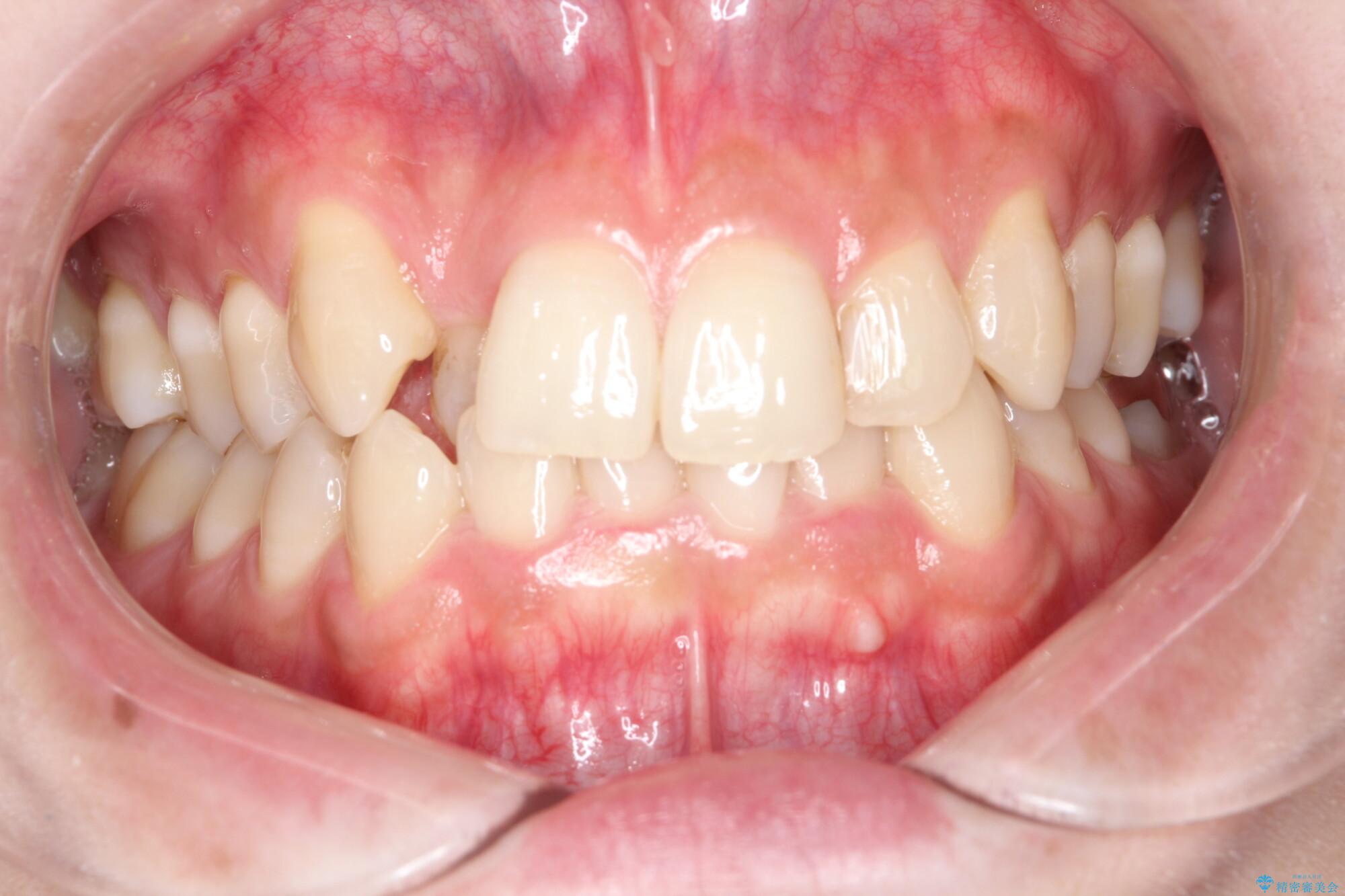 八重歯を抜歯せずにインビザラインで矯正 治療前