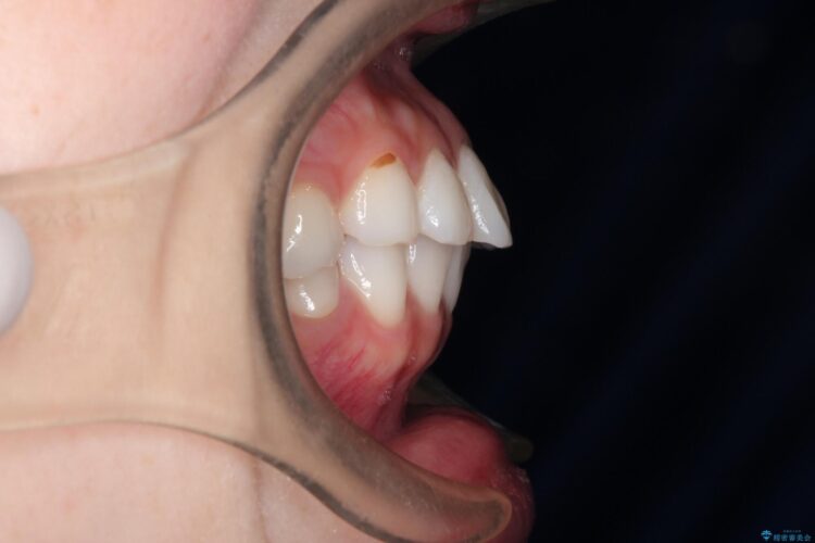 口が閉じにくい　口ゴボの抜歯矯正による改善 治療前画像