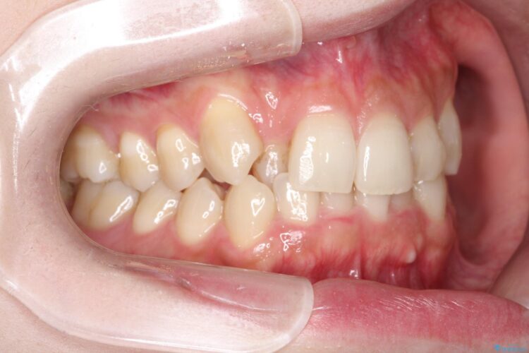 八重歯を抜歯せずにインビザラインで矯正 治療前画像
