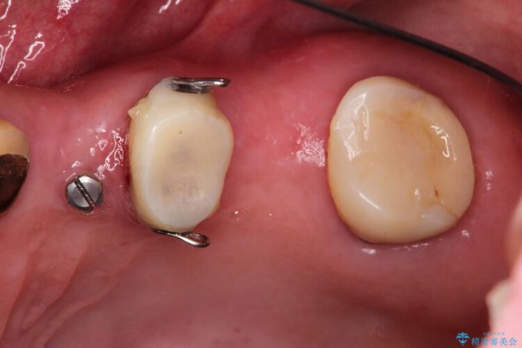 部分矯正で歯を正しい位置に移動しインプラント治療を行った症例 治療途中画像