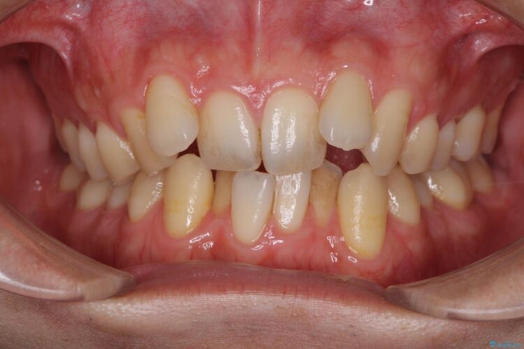 前歯のガタガタをきれいにしたい　ワイヤーによる抜歯矯正で整った歯並びへ ビフォー