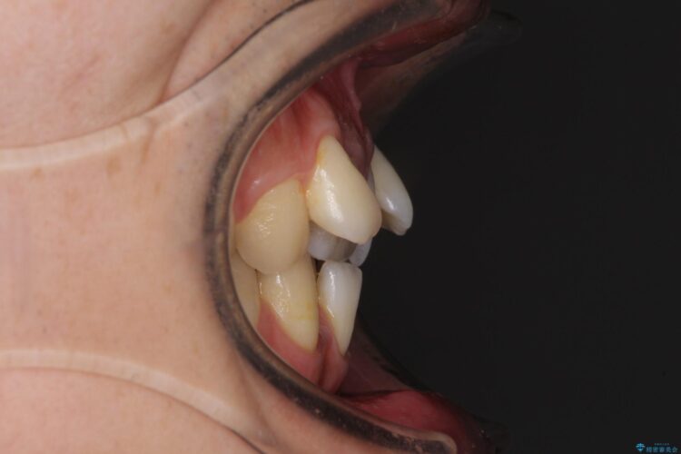 前歯のガタガタをきれいにしたい　ワイヤーによる抜歯矯正で整った歯並びへ 治療前画像