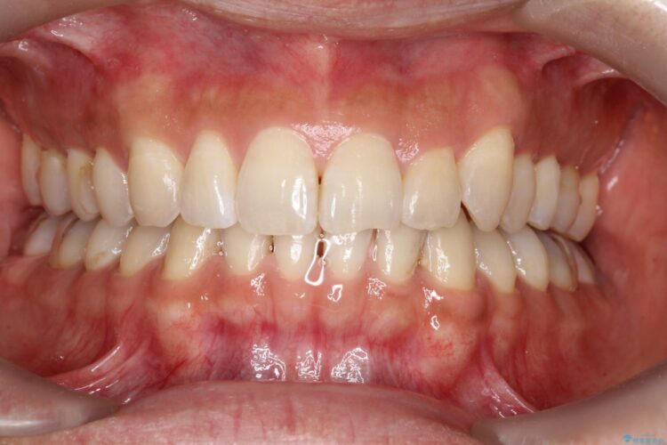八重歯をインビザラインで矯正　成人の目立たない矯正 アフター