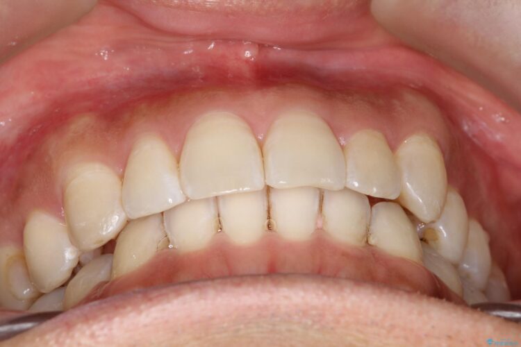 八重歯をインビザラインで矯正　成人の目立たない矯正 治療後画像