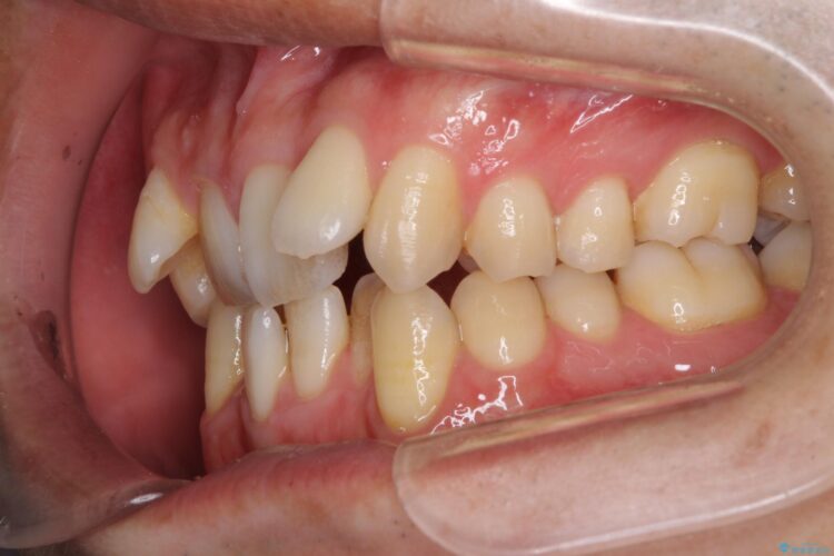 前歯のガタガタをきれいにしたい　ワイヤーによる抜歯矯正で整った歯並びへ 治療前画像