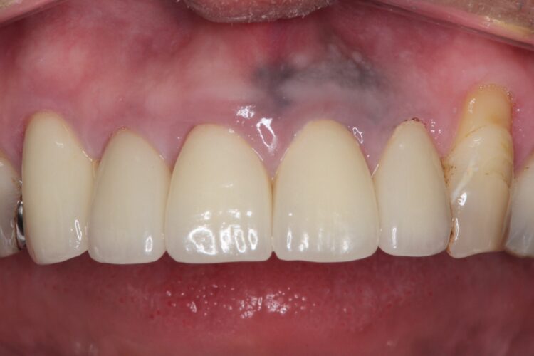 上の前歯の根元が黒い　根の治療をしてからセラミックの再治療 治療後画像