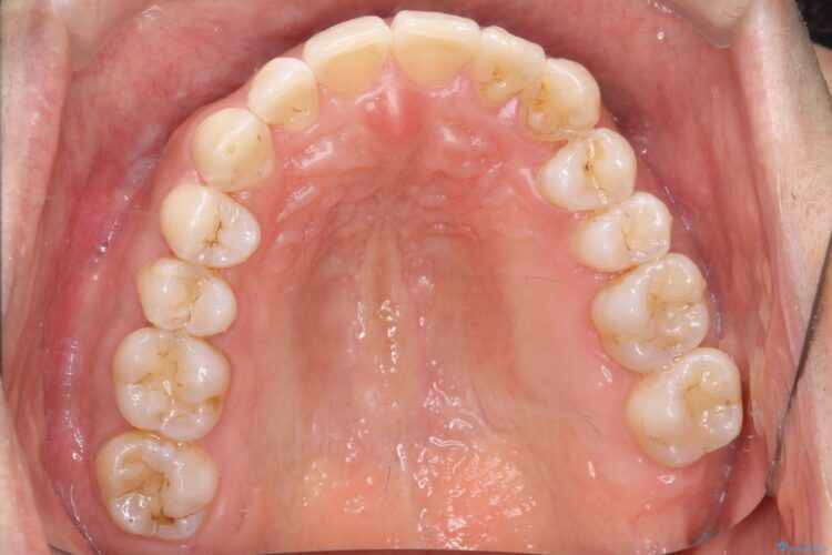 八重歯をインビザラインで矯正　成人の目立たない矯正 治療後画像